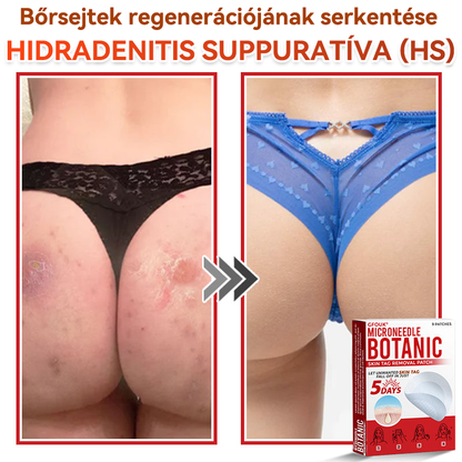 ✨GFOUK® Mikrotűs növényi bőrkinövés eltávolító tapasz