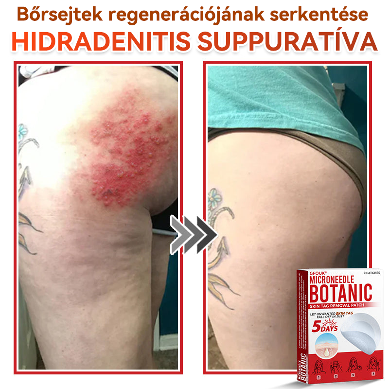 ✨GFOUK® Mikrotűs növényi bőrkinövés eltávolító tapasz