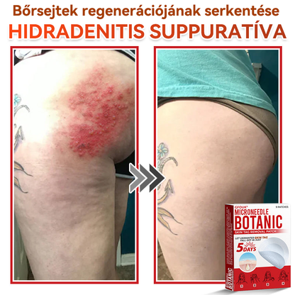✨GFOUK® Mikrotűs növényi bőrkinövés eltávolító tapasz