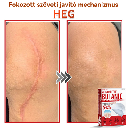 ✨GFOUK® Mikrotűs növényi bőrkinövés eltávolító tapasz