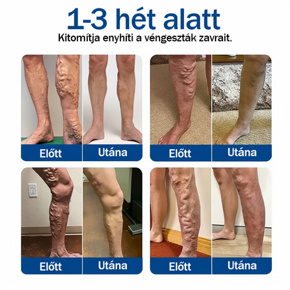 🏆🇭🇺👨‍⚕️✅TAILEDEN® VeinEase Mikrotűs Kezelő Tapasz⚡Azonnali Megkönnyebbülés, Hosszú Távú Eredmények