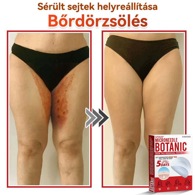 ✨GFOUK® Mikrotűs növényi bőrkinövés eltávolító tapasz
