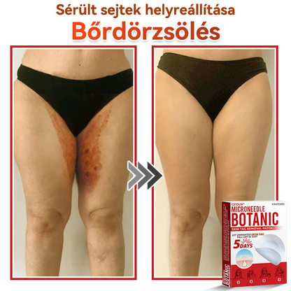 ✨GFOUK® Mikrotűs növényi bőrkinövés eltávolító tapasz
