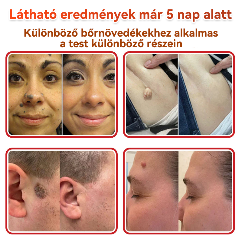 ✨GFOUK® Mikrotűs növényi bőrkinövés eltávolító tapasz