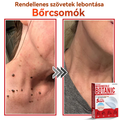 ✨GFOUK® Mikrotűs növényi bőrkinövés eltávolító tapasz