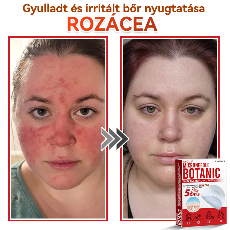 ✨GFOUK® Mikrotűs növényi bőrkinövés eltávolító tapasz