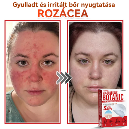 ✨GFOUK® Mikrotűs növényi bőrkinövés eltávolító tapasz