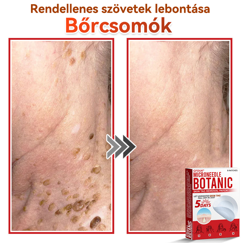 ✨GFOUK® Mikrotűs növényi bőrkinövés eltávolító tapasz