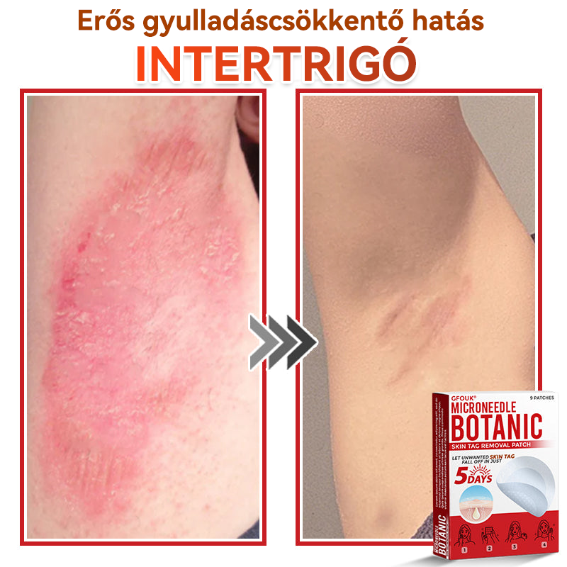 ✨GFOUK® Mikrotűs növényi bőrkinövés eltávolító tapasz